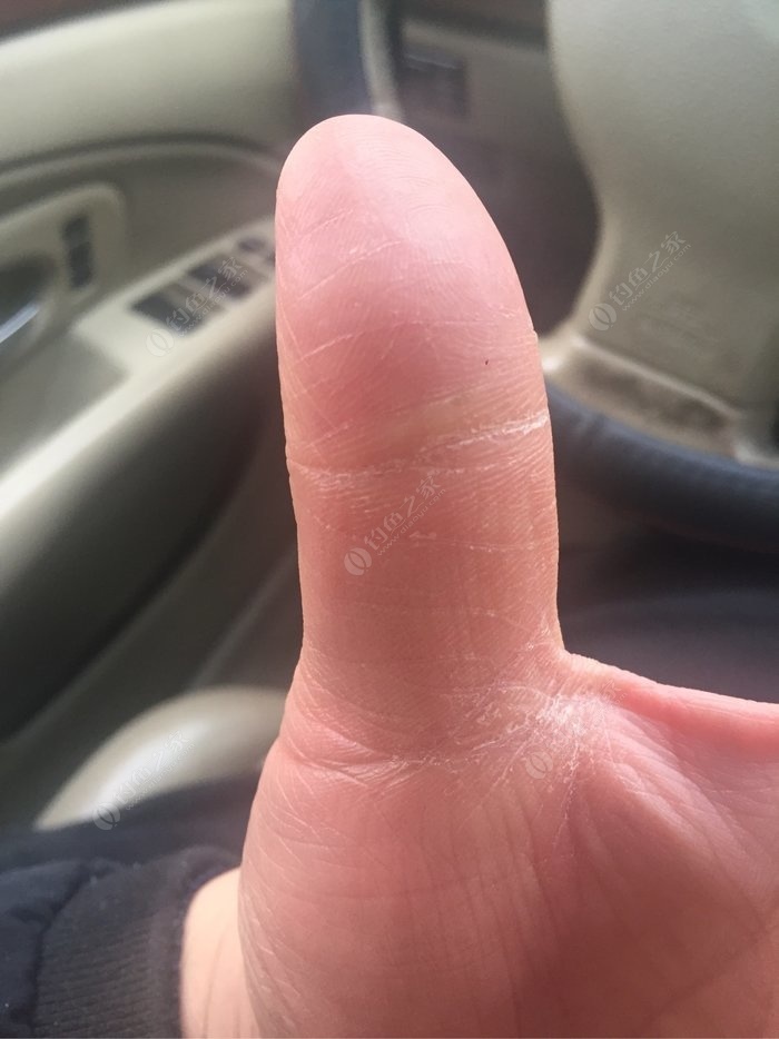 这个大拇指一直在脱皮,该买什么药来搽?